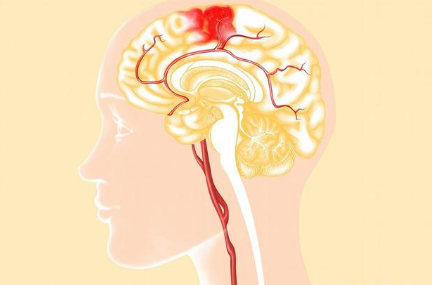 腦出血新型輔助治療手段—三氧免疫自血療法